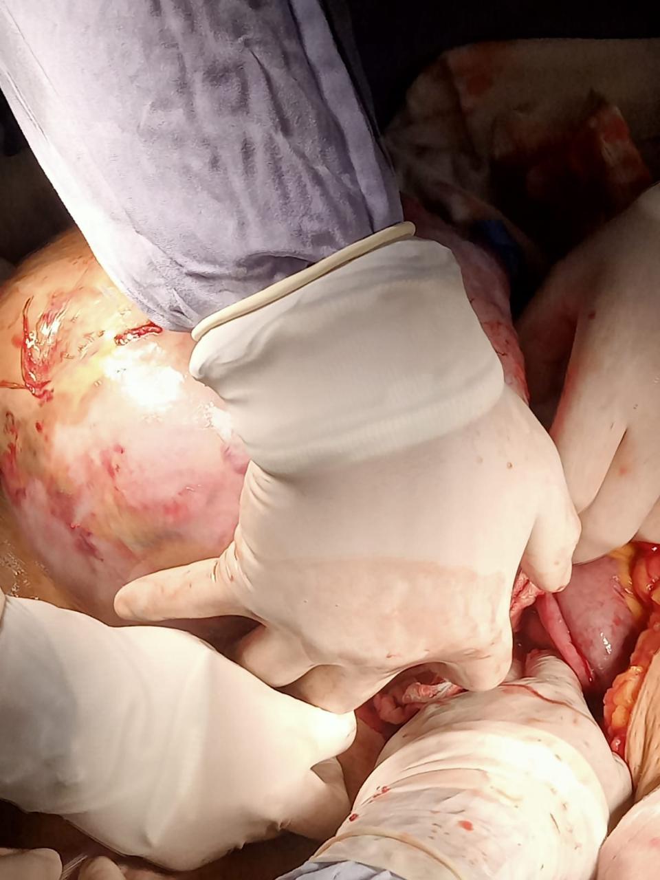 Procedimiento ginecológico realizado por el equipo médico