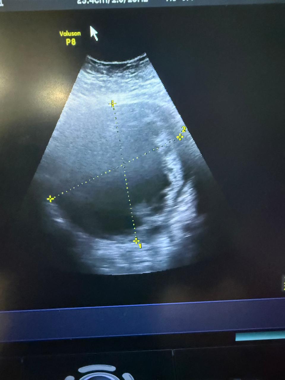 Imagen de ultrasonido utilizada durante la evaluación ginecológica