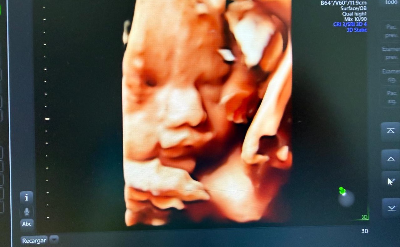 Vista frontal del rostro del bebé en ultrasonido 4D