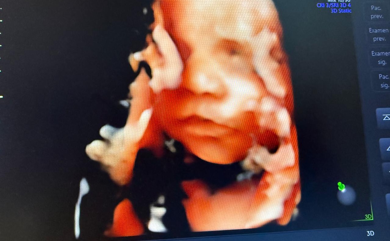 Imagen del rostro y manos del bebé en ultrasonido 4D
